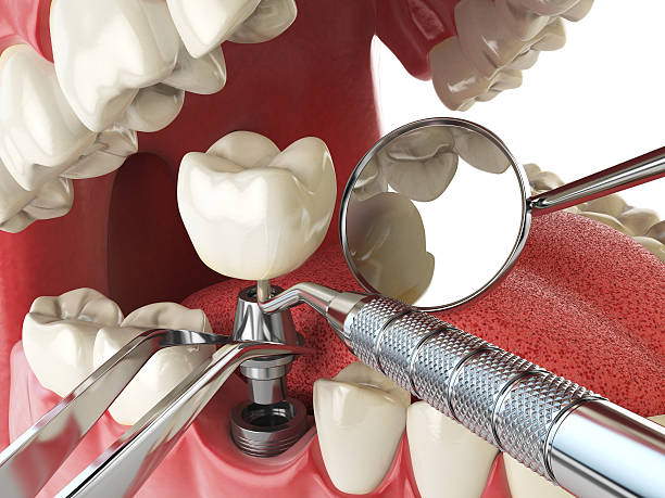 Best Chipped Tooth Repair Near Me  in Knoxville, TN